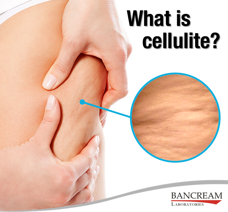 what_is_cellulite.png